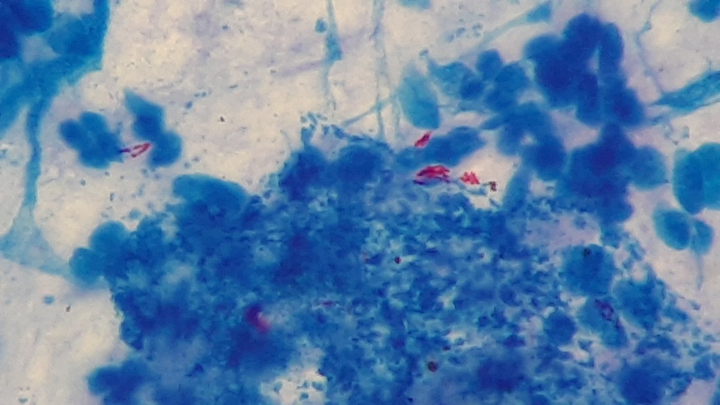 Acid-fast bacilli: red rods on a blue background in a Ziehl-Neelsen stain