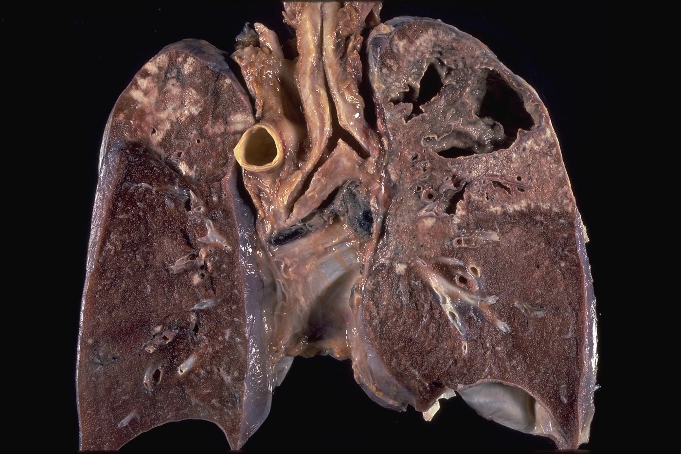 A slice of lung with cavitary tuberculosis: caseation and cavities in the upper parts