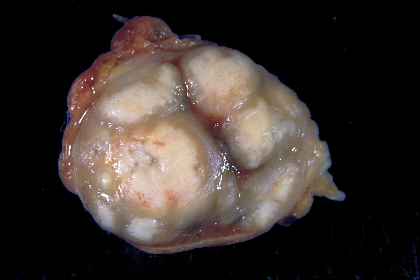 A lymph node cut across, with pale caseous material replacing most of it
