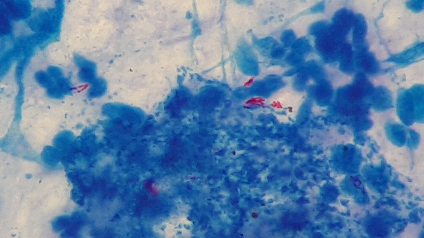 Acid-fast bacilli: red rods on a blue background in a Ziehl-Neelsen stained sputum smear