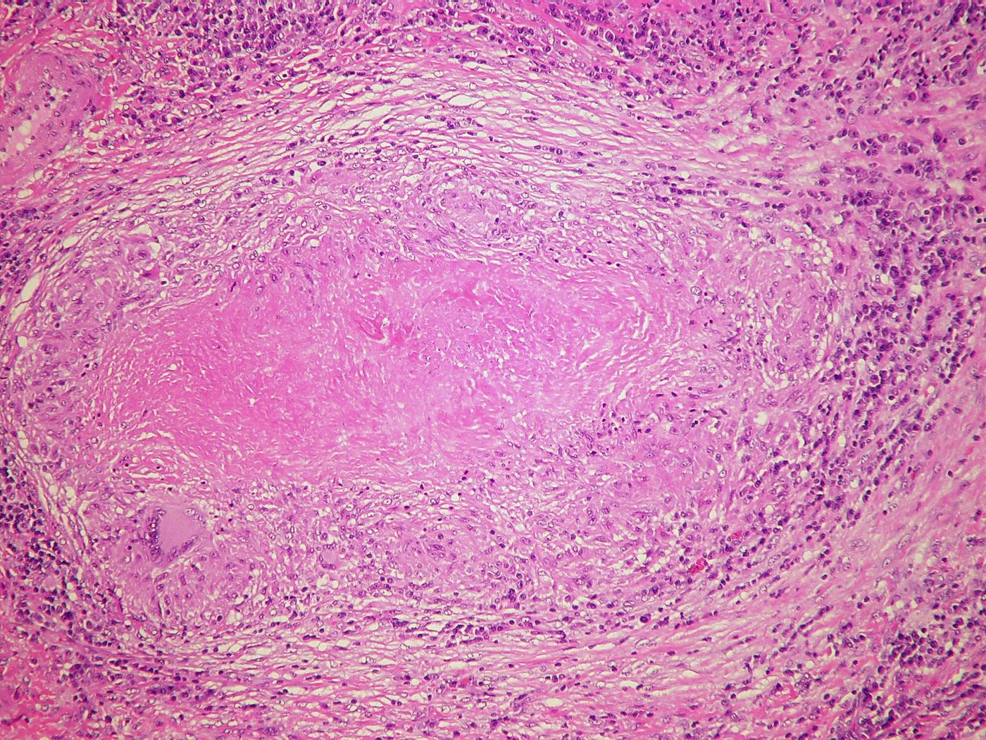 Caseous necrosis at the centre of a tuberculous granuloma, under the microscope
