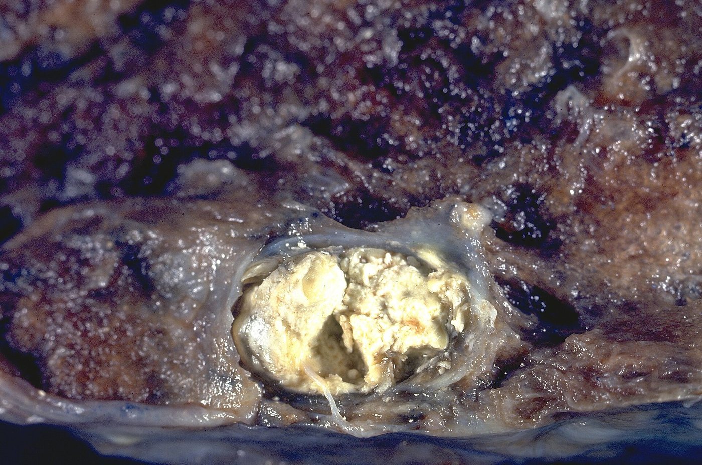 A Ghon focus: a single small caseous lesion just under the pleura of the lung