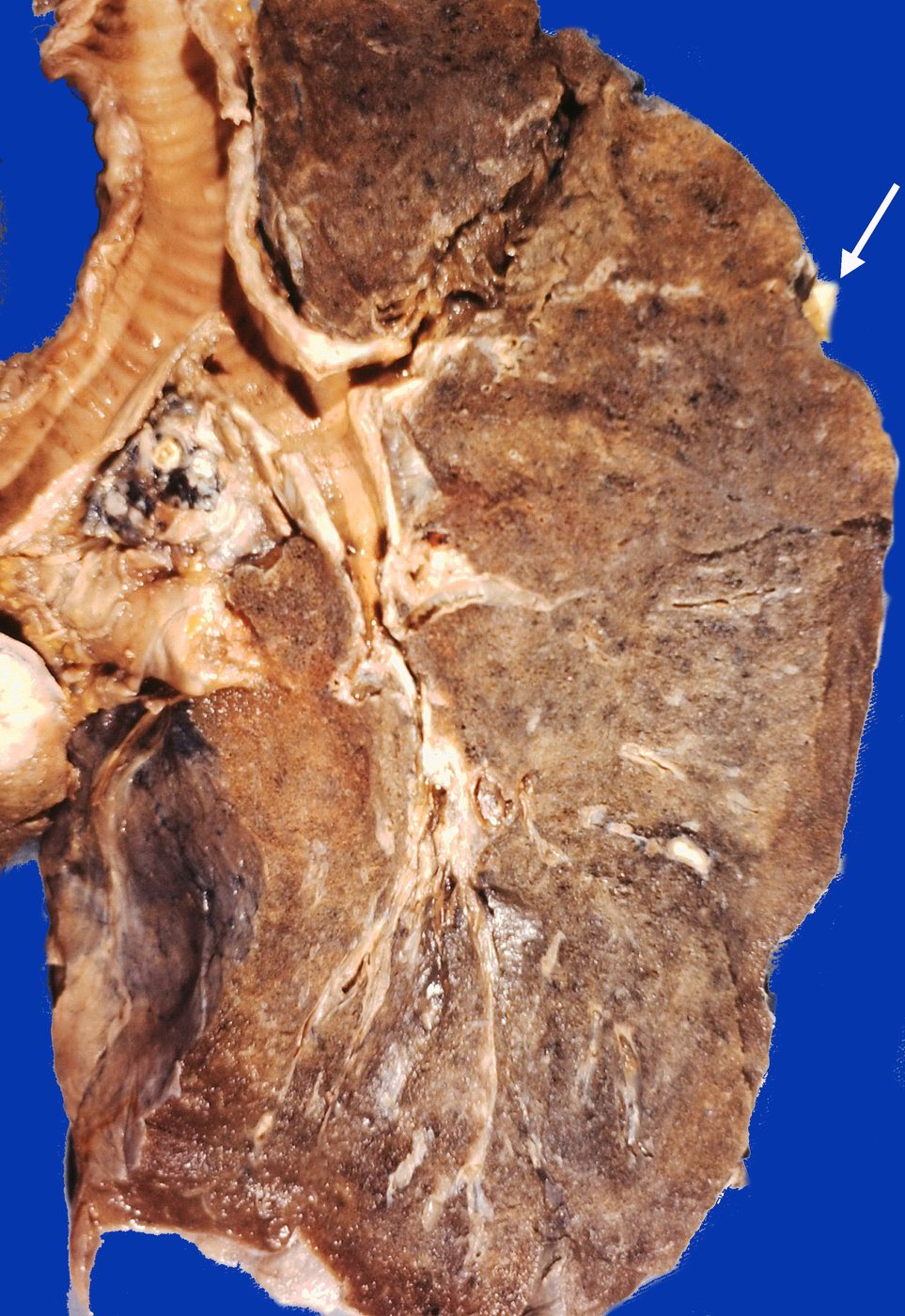 A Ranke complex: a calcified nodule under the pleura and a calcified hilar lymph node