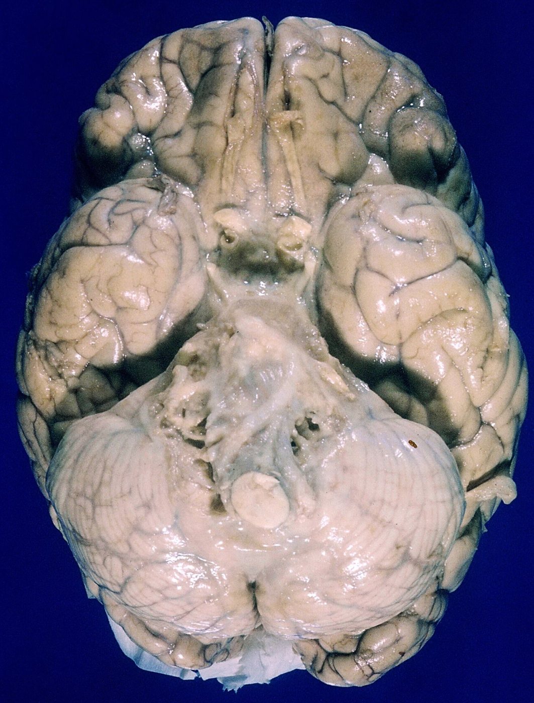 Tuberculous meningitis: thick grey exudate over the base of the brain