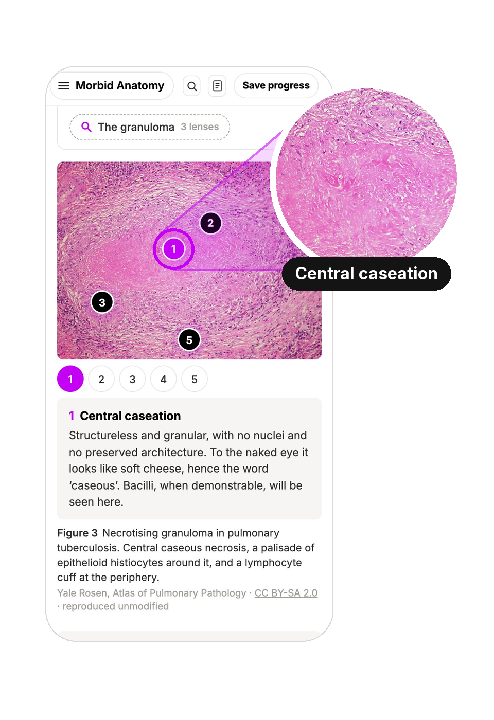 patandfam on a phone: a granuloma slide with its centre, central caseation, magnified